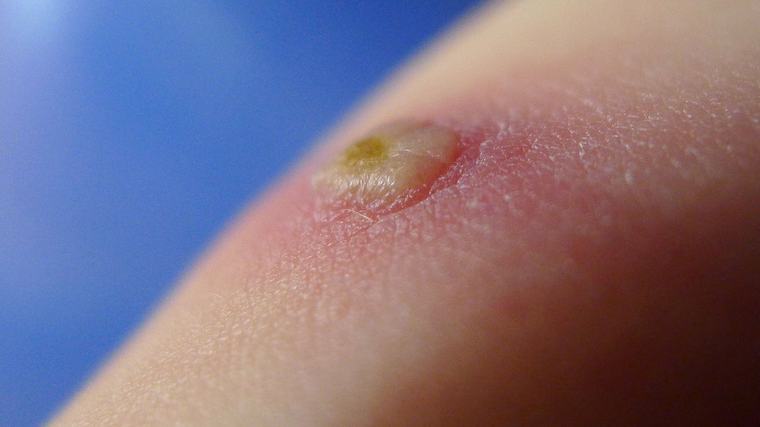 Anmälningsplikt för vattkoppor och RS-virus