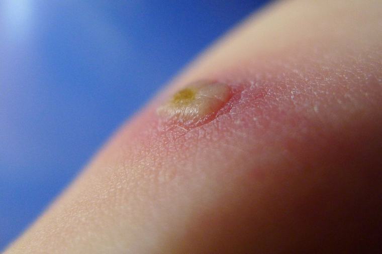 Anmälningsplikt för vattkoppor och RS-virus